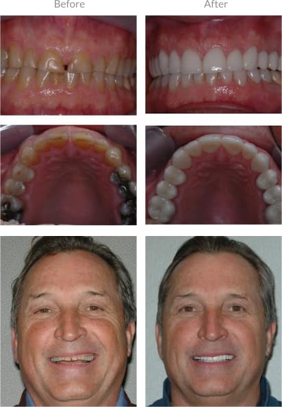 worn-teeth-before-and-after