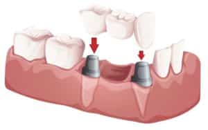 Diagram of Dental Implants