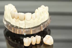 What are Dental Crowns and Bridges and Who Benefits from Them?
