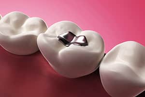 Can I Leave in My Silver Fillings? An Expert Opinion