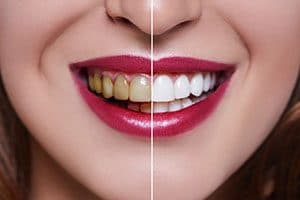 What is Cosmetic Dentistry and is it Right for You?