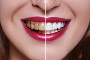 What is Cosmetic Dentistry and is it Right for You?