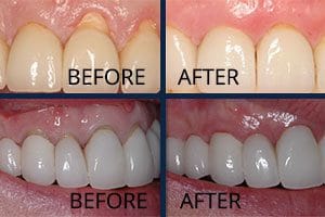 What is PST Gum Treatment?