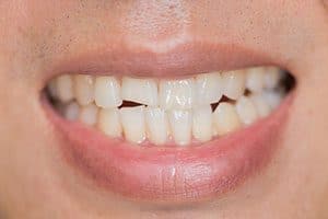 What to Do If You Chip a Tooth
