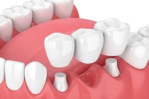 How Do Porcelain Bridges Work?