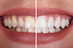 How to Care for Your Teeth Following a Zoom! Teeth Whitening Treatment