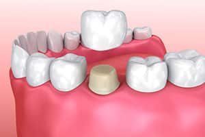 What to do When a Dental Crown Falls Out