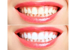 Picture of teeth before and after whitening.