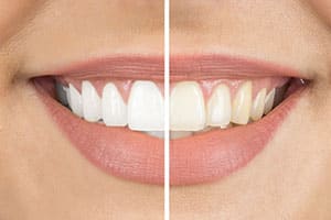 Closeup of before and after teeth whitening smile.