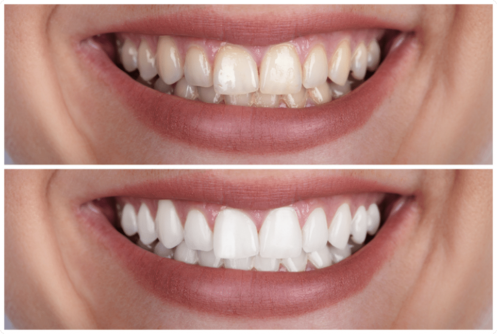 Teeth whitening before and after closeup of smile.