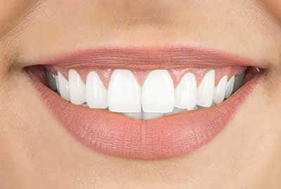 Beautiful Smile Using Lumineers for Teeth Whitening in Metro Detroit