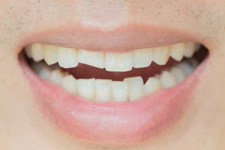Closeup of chipped tooth smile.