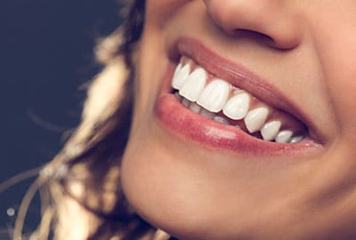Closeup of Woman's Smile Showing Lumineers for Teeth Whitening near Troy MI