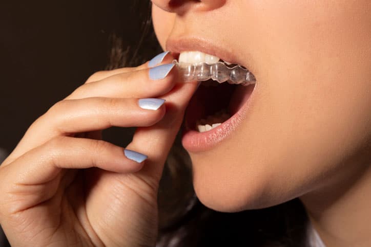 Closeup of Woman Putting Clear Braces in Her Mouth