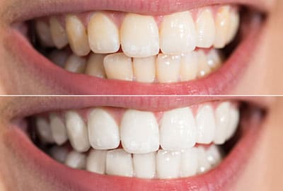Close-up Detail Of Person Teeth Showing Before And After Teeth Whitening near Rochester MI