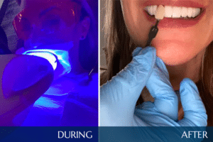 During and After Zoom Teeth Whitening