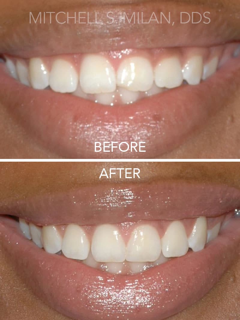 Chipped Upper Teeth Repaired with Dental Bonding