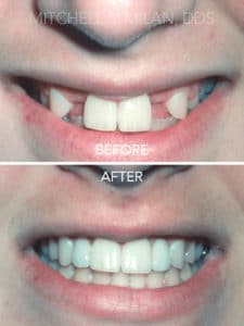 Congenitally Missing Lateral Incisors Corrected with All Porcelain Bridges