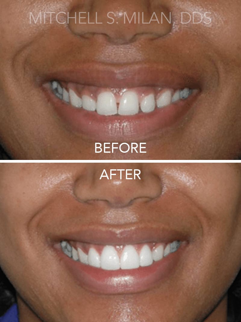 Excessive Gaps and Gummy Smile with Short Teeth Corrected with Laser Gum Contouring and Porcelain Veneers