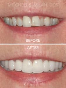 Extremely Crooked Discolored Teeth Corrected with Porcelain Veneers