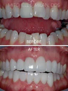Extremely Crooked Maligned Teeth Corrected with Porcelain Veneers and Dental Crowns