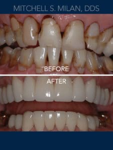 Extremely Worn, Stained and Broken Teeth Restored with Porcelain Veneers and Dental Crowns