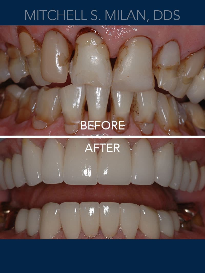 Extremely Worn, Stained and Broken Teeth Restored with Porcelain Veneers and Dental Crowns