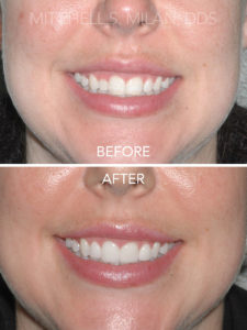 Gummy Smile with Short Teeth Restored with Laser Gum Lift and Porcelain Veneers