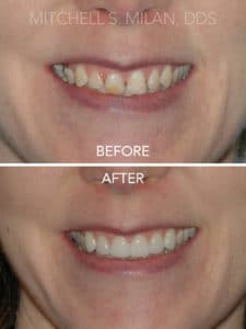 Malformed Teeth with Gaps and Gummy Smile Corrected with Laser Gum Contouring and Porcelain Veneers