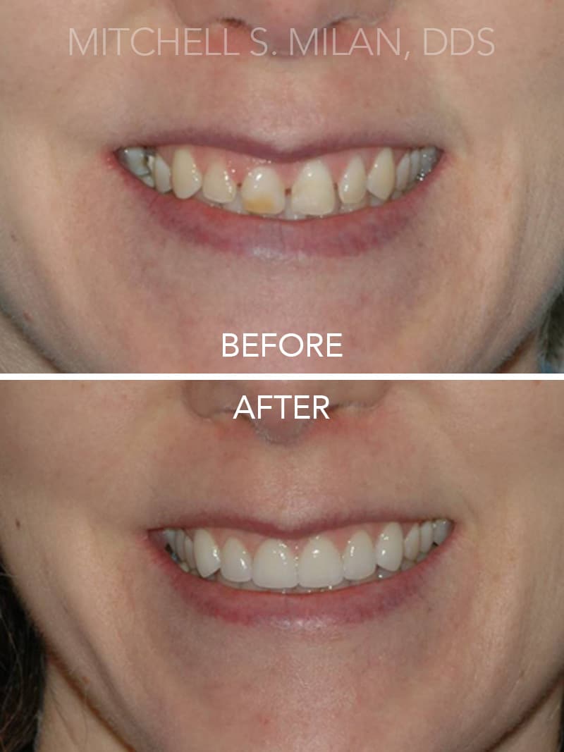 Malformed Teeth with Gaps and Gummy Smile Corrected with Laser Gum Contouring and Porcelain Veneers