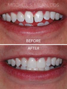 Misshaped and Missing Teeth Corrected with Porcelain Veneers