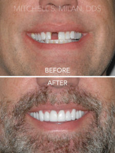 Missing Front Tooth Corrected with Dental Implant and Porcelain Veneers