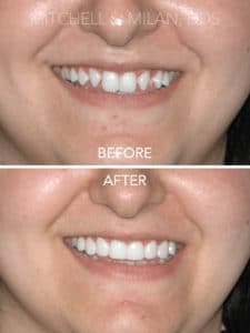 Missing Laterals Incisors Corrected with Porcelain Veneers