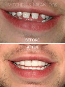 Missing and Maligned Teeth Corrected with Porcelain Veneers and Bridgework