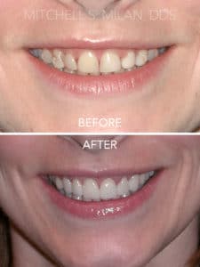 Old Bonding and Gummy Smile Corrected with Laser Gum Contouring and Porcelain Veneers