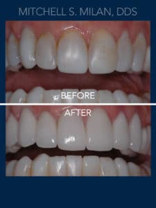 Old Stained Teeth with Bonding Replaced with Long-lasting Porcelain Veneers