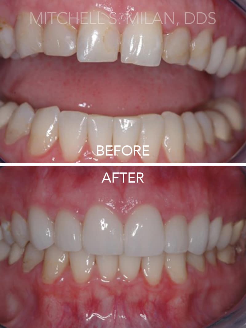Old Stained Bonding with Poorly Shaped Teeth Corrected with Porcelain Veneers