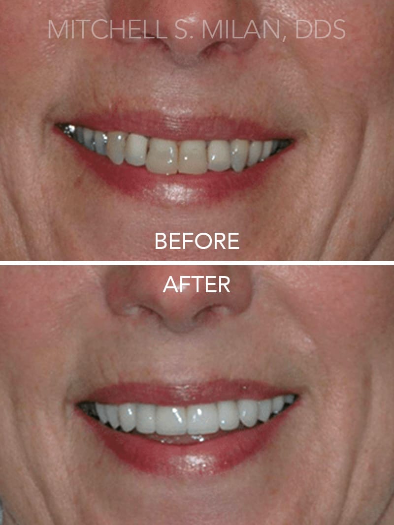 Old Unsightly Dental Crowns Corrected with New Porcelain Dental Crowns