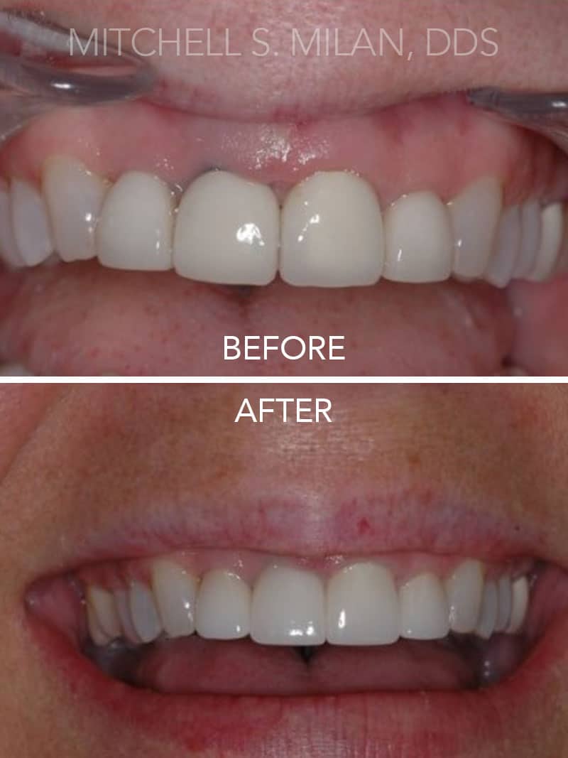 Poorly Contoured Gums with Unsightly Crowns Corrected with Gum Contouring and Porcelain Crowns