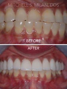 Severely Worn Teeth from Grinding Corrected with Porcelain Veneers