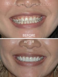Small Teeth Gummy Smile Corrected with Laser Gum Contouring and Porcelain Veneers