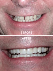 Spaces and Crooked Teeth Corrected with Porcelain Veneers