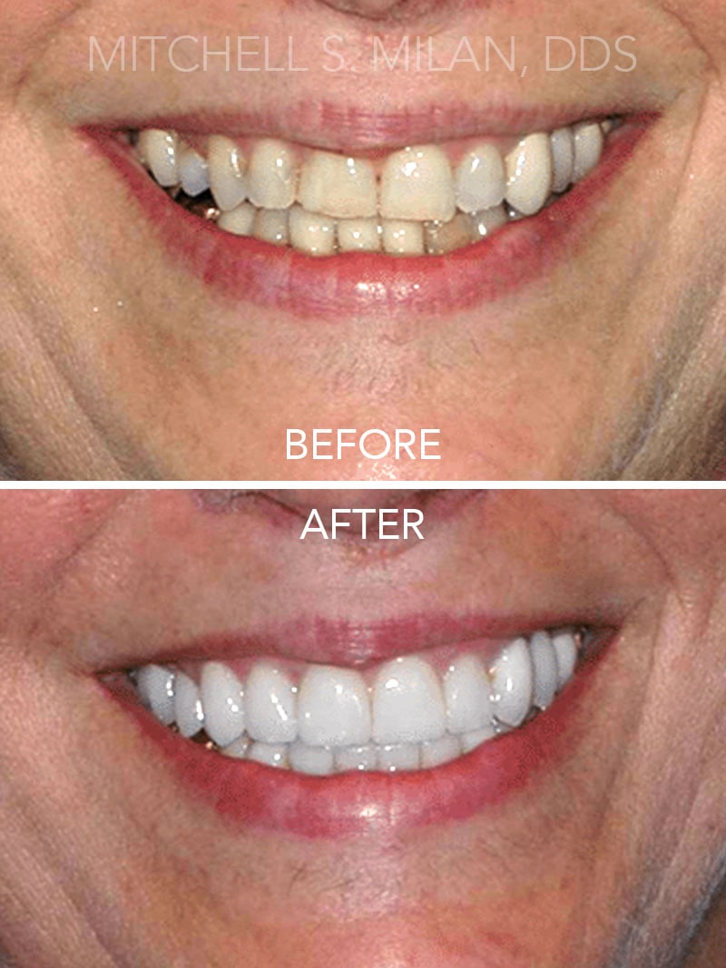 Stained Crooked Teeth Corrected with Porcelain Veneers