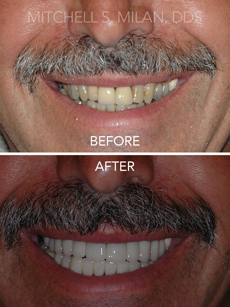 Stained Teeth with Old Crowns Restored with Porcelain Veneers Crowns