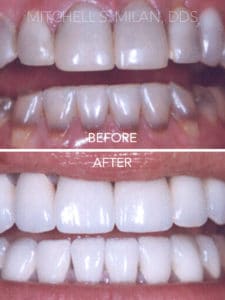Tetracycline-Stained Teeth Corrected with Porcelain Veneers