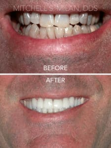 Tetracycline-Stained Teeth Corrected with Full Mouth Porcelain Veneers