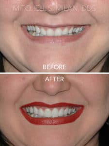Tipped In Teeth with Bad Bite Corrected with Laser Gum Contouring and Porcelain Veneers