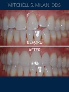Uneven Poorly Shaped Teeth Corrected with Porcelain Veneers