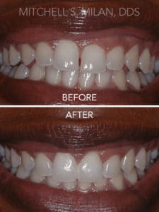 Uneven Teeth Gums Corrected with Laser Gum Contouring