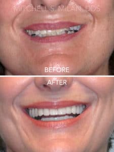 Uneven Worn Teeth Corrected with Porcelain Veneers Dental Crowns